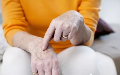 皮膚長老年斑怎么去掉，學(xué)會4招“吃”掉老年斑