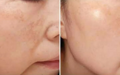 都說祛斑難，對不起，那是他因為你沒選對方法！